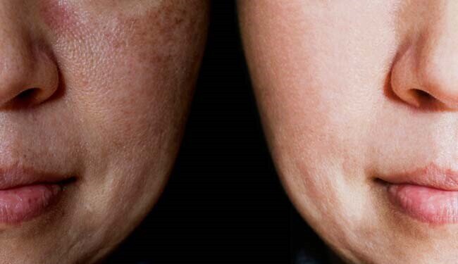 The Rules of Fighting Pigmentation
