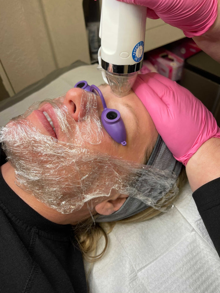 Microneedling RF: The Benefits of Radiofrequency Microneedling