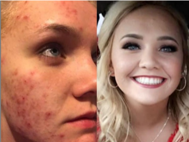 Clear Skin Solutions: Real People, Real Results
