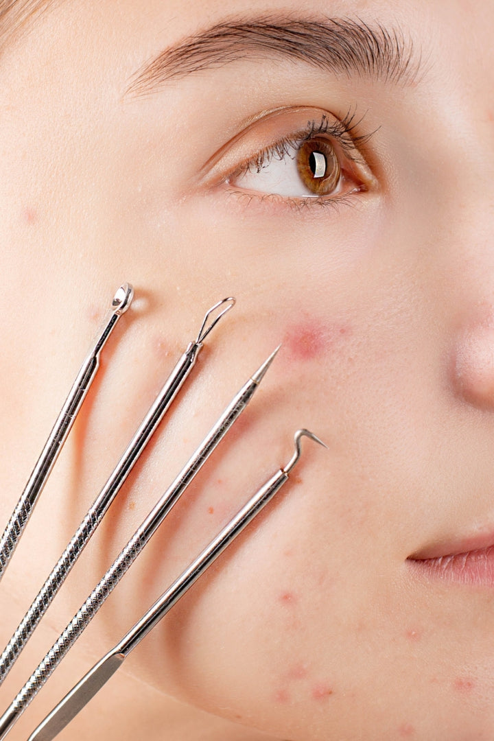 Acne is a Disease, Not a Condition: What to Know (and How to Treat It)