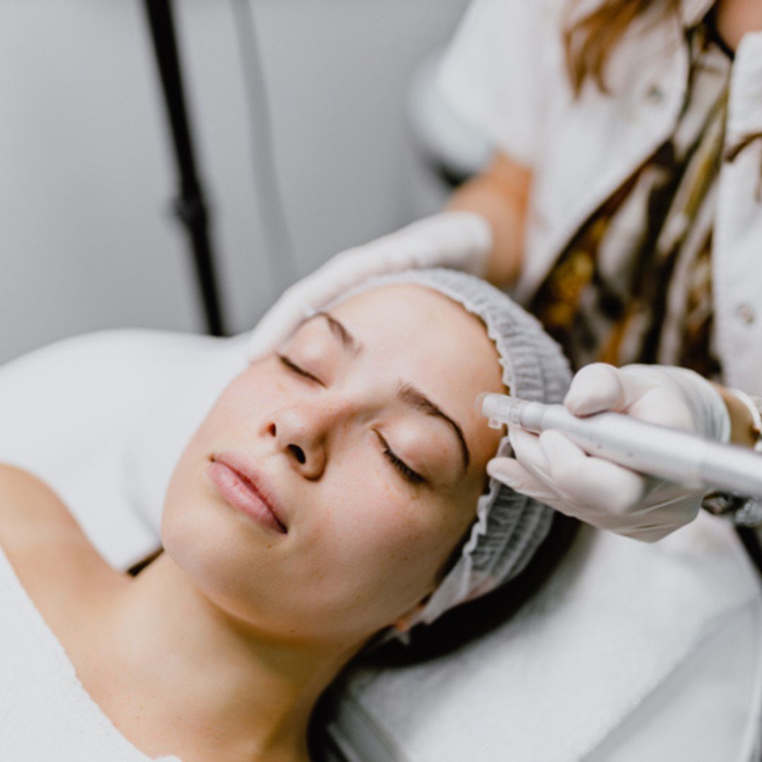 Rejuvenate Your Skin with Microneedling: Unleash the Secret to Flawless Complexion