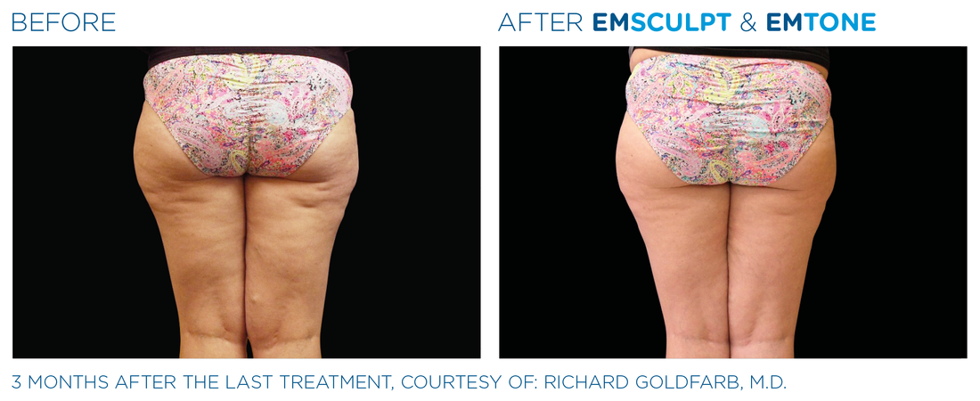 Discover Non-Invasive Body Contouring Solutions for a Toned, Confident You in 2024