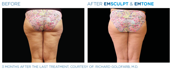Discover Non-Invasive Body Contouring Solutions for a Toned, Confident You in 2024