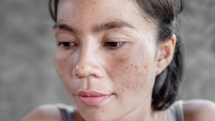 Achieving a Flawless Complexion: How to Combat Hyperpigmentation and Uneven Skin Tone