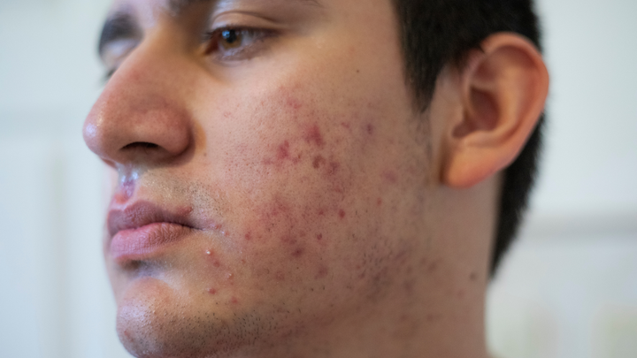 Conquer Acne with Expert Skincare Strategies and Treatments